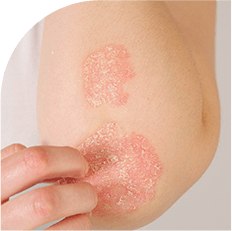 psoriasis