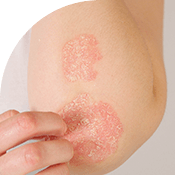 psoriasis