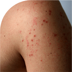 skin rashes